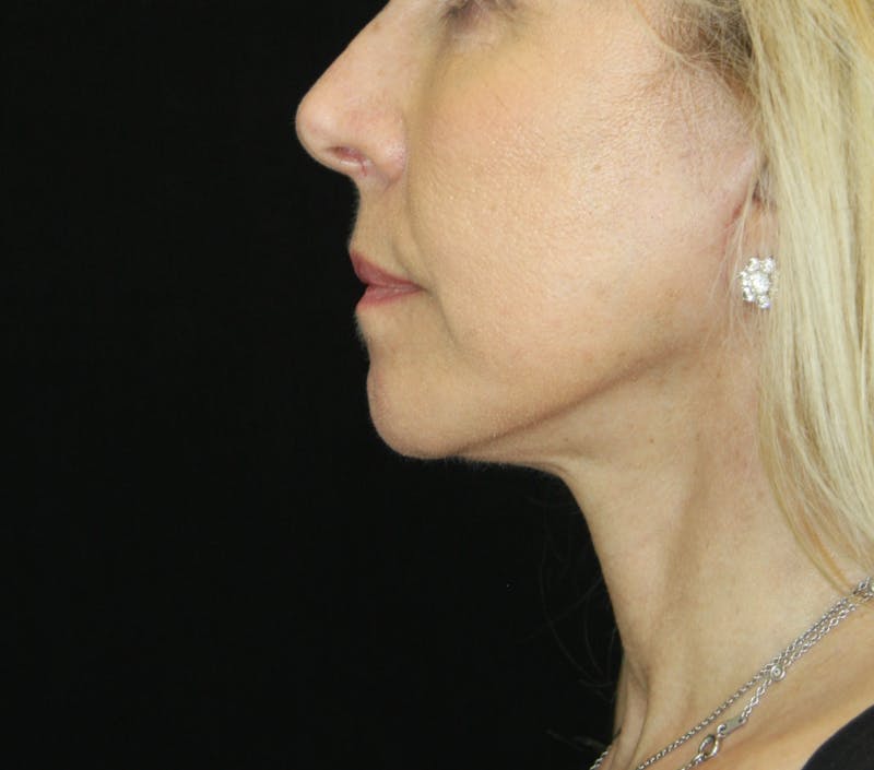 Facelift & Neck Lift Before & After Gallery - Patient 179437033 - Image 10