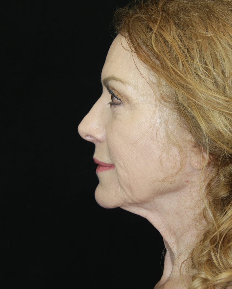 Facelift & Neck Lift Before & After Gallery - Patient 179454516 - Image 5