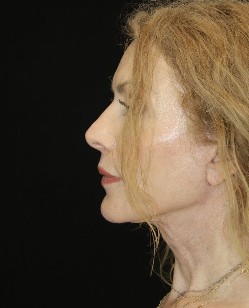 Facelift & Neck Lift Before & After Gallery - Patient 179454516 - Image 6
