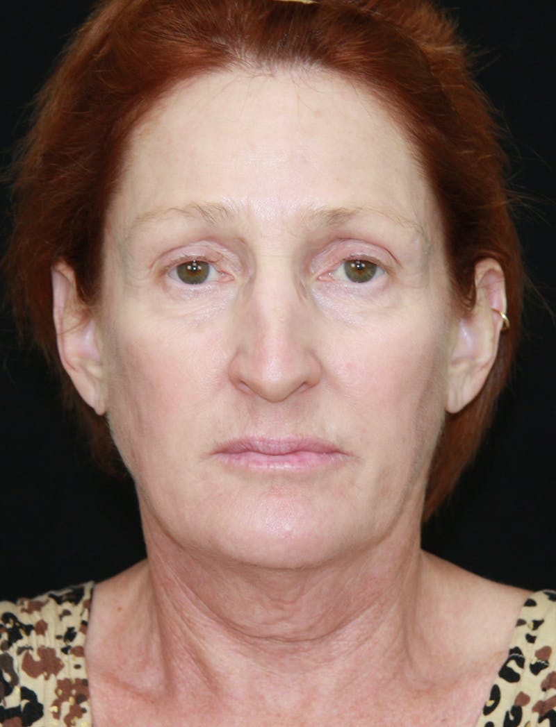 Facelift & Neck Lift Before & After Gallery - Patient 179484438 - Image 1