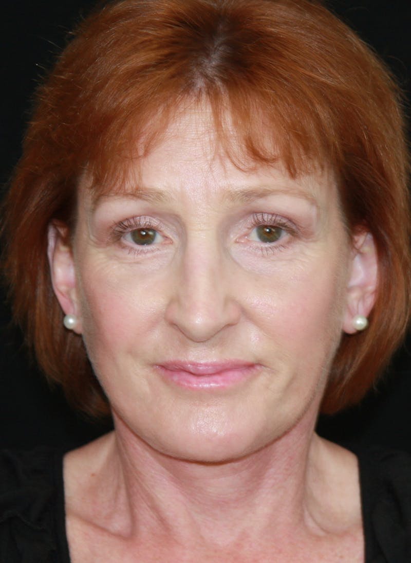 Facelift & Neck Lift Before & After Gallery - Patient 179484438 - Image 2