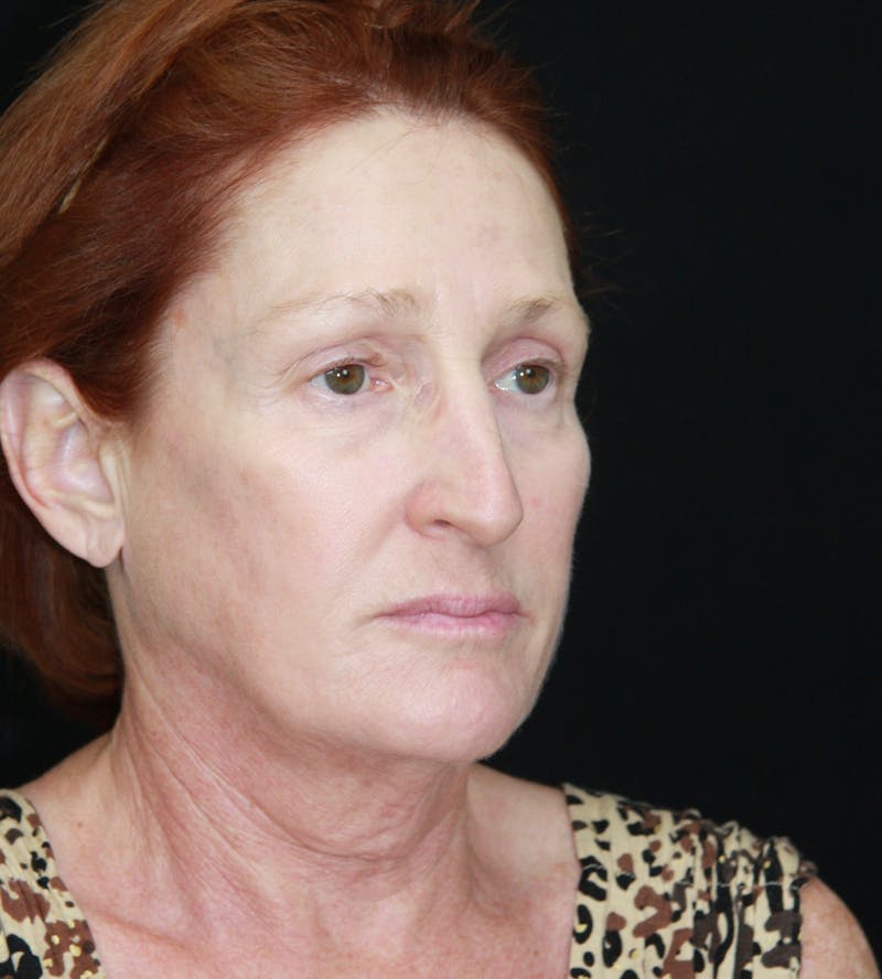 Facelift & Neck Lift Before & After Gallery - Patient 179484438 - Image 3