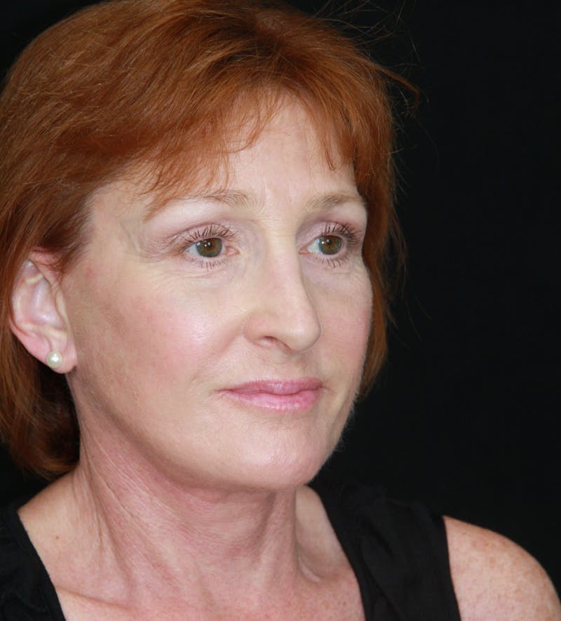 Facelift & Neck Lift Before & After Gallery - Patient 179484438 - Image 4