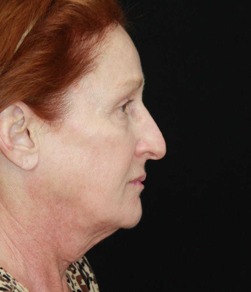 Facelift & Neck Lift Before & After Gallery - Patient 179484438 - Image 5