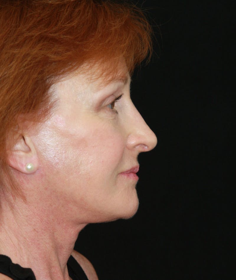 Facelift & Neck Lift Before & After Gallery - Patient 179484438 - Image 6
