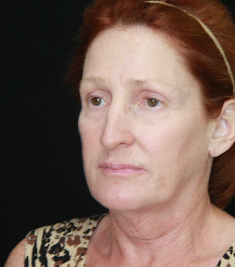 Facelift & Neck Lift Before & After Gallery - Patient 179484438 - Image 7