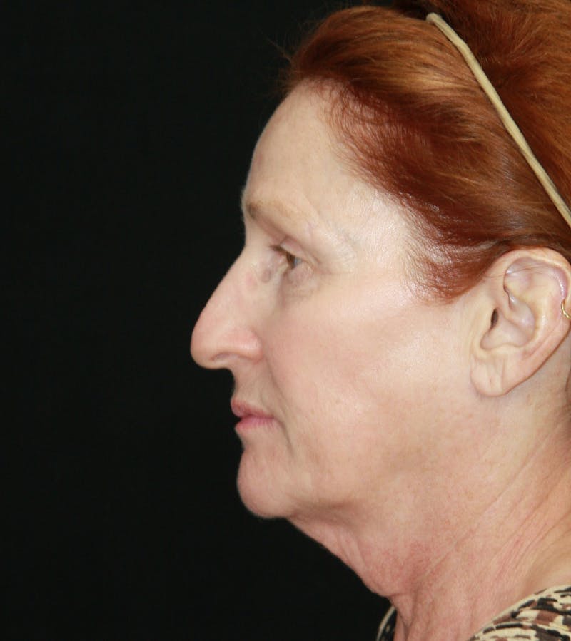 Facelift & Neck Lift Before & After Gallery - Patient 179484438 - Image 9