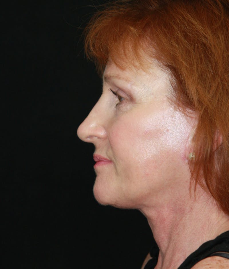 Facelift & Neck Lift Before & After Gallery - Patient 179484438 - Image 10