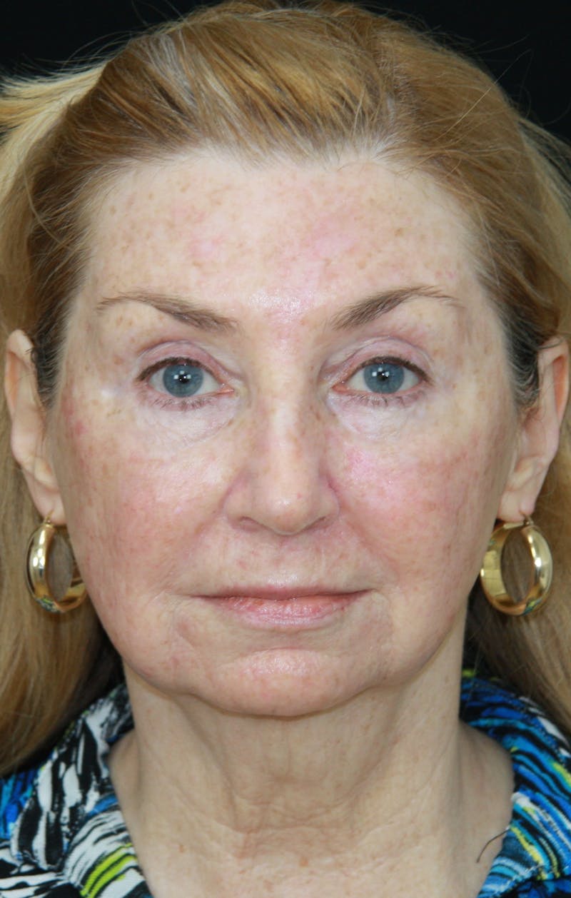 Facelift & Neck Lift Before & After Gallery - Patient 179484564 - Image 1