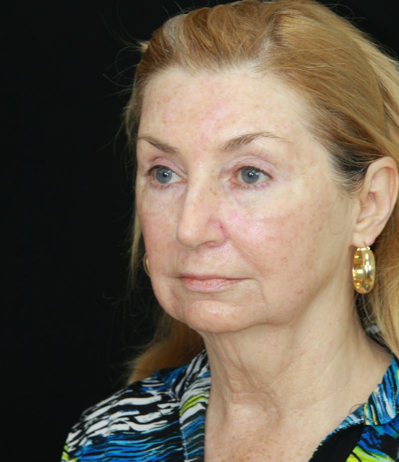 Facelift & Neck Lift Before & After Gallery - Patient 179484564 - Image 3