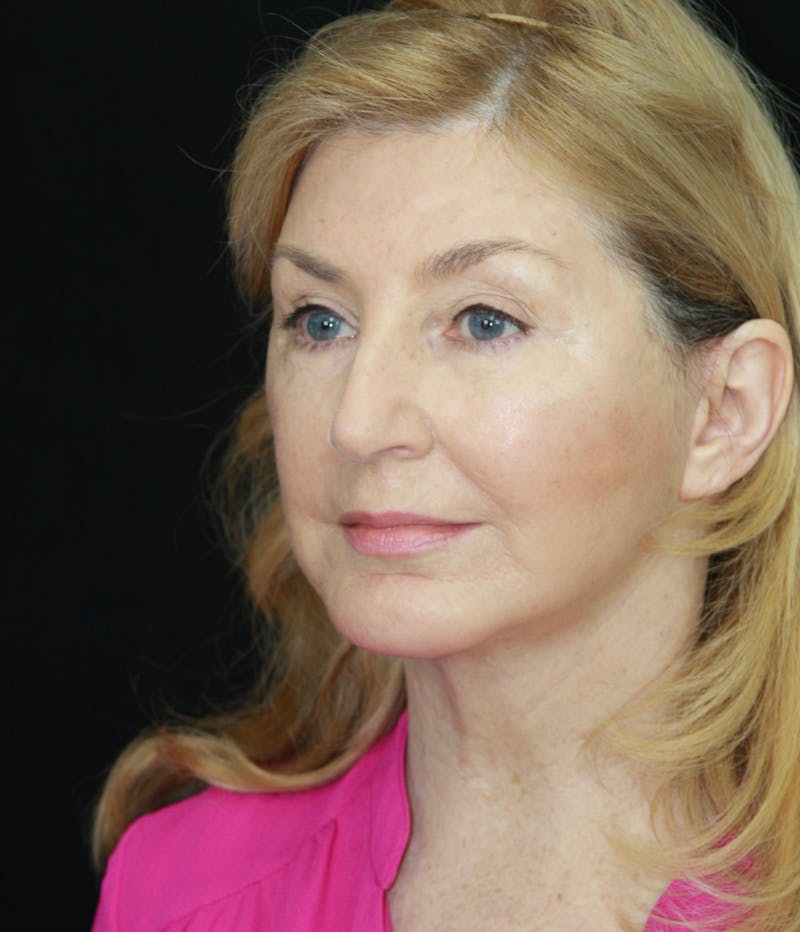 Facelift & Neck Lift Before & After Gallery - Patient 179484564 - Image 4