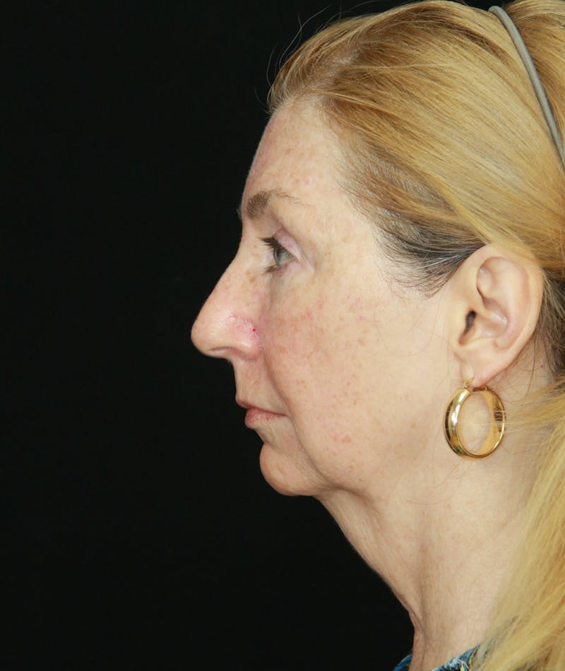 Facelift & Neck Lift Before & After Gallery - Patient 179484564 - Image 5