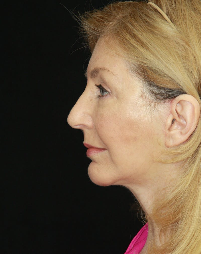 Facelift & Neck Lift Before & After Gallery - Patient 179484564 - Image 6