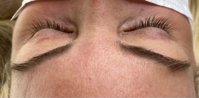 Eyelash Extensions Before & After Gallery - Patient 181016901 - Image 1