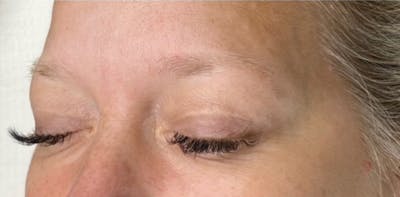 Microblading Before & After Gallery - Patient 181016984 - Image 1