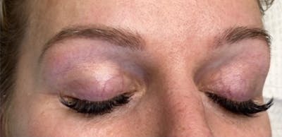 Microblading Before & After Gallery - Patient 181017012 - Image 1