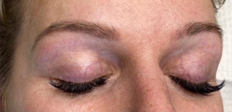 Microblading Before & After Gallery - Patient 181017012 - Image 1
