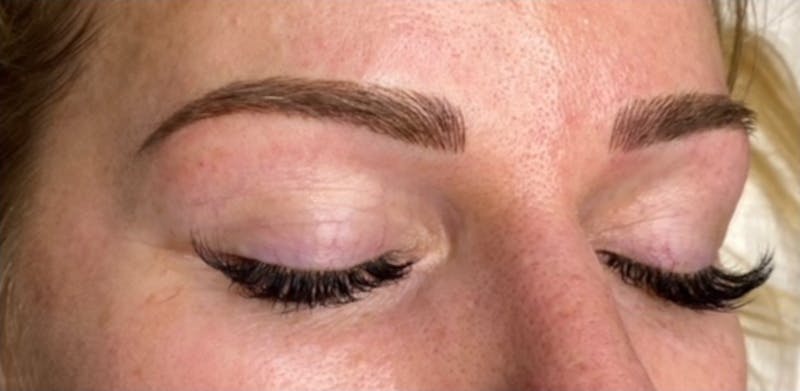Microblading Before & After Gallery - Patient 181017012 - Image 2
