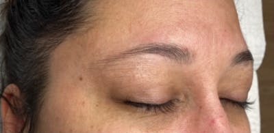 Microblading Before & After Gallery - Patient 181017036 - Image 1