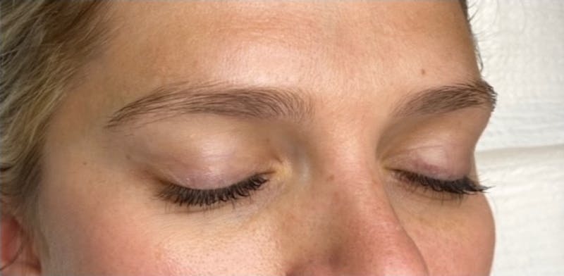 Microblading Before & After Gallery - Patient 181017074 - Image 1
