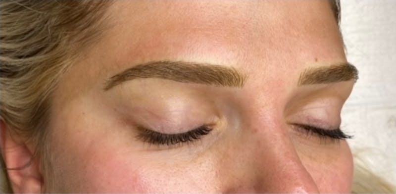 Microblading Before & After Gallery - Patient 181017074 - Image 2