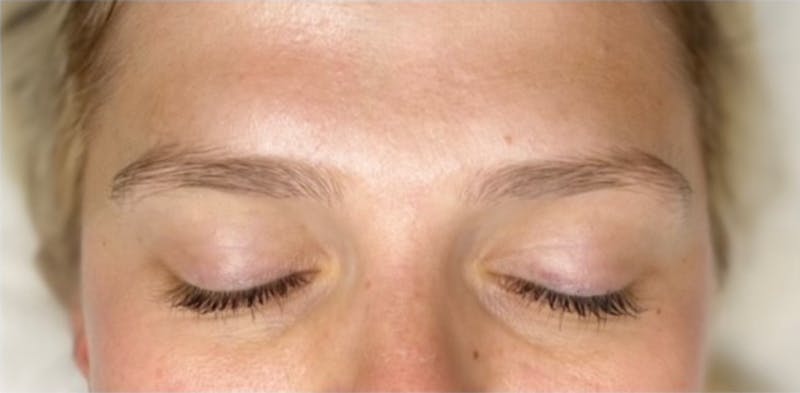 Microblading Before & After Gallery - Patient 181019958 - Image 1