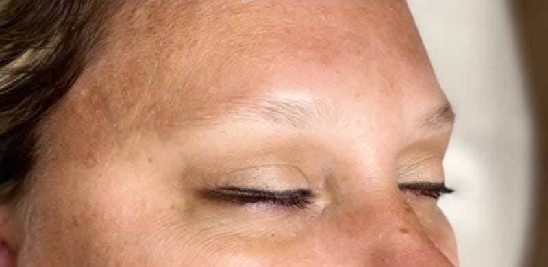 Microblading Before & After Gallery - Patient 181020146 - Image 1