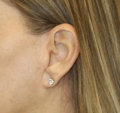 Incisions Before & After Gallery - Patient 181783074 - Image 1
