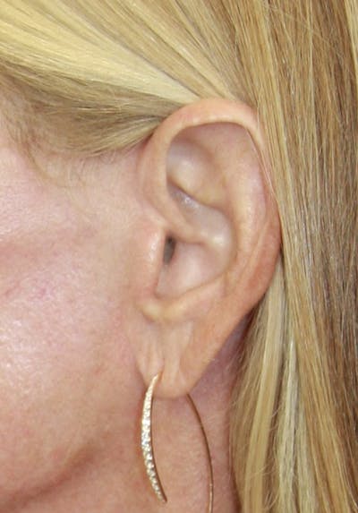 Incisions Before & After Gallery - Patient 181783092 - Image 1