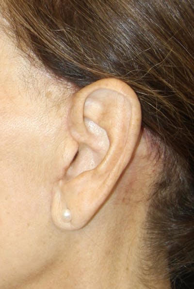 Incisions Before & After Gallery - Patient 181783098 - Image 1