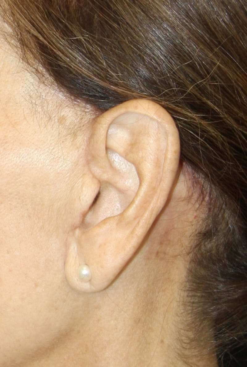 Incisions Before & After Gallery - Patient 181783098 - Image 1