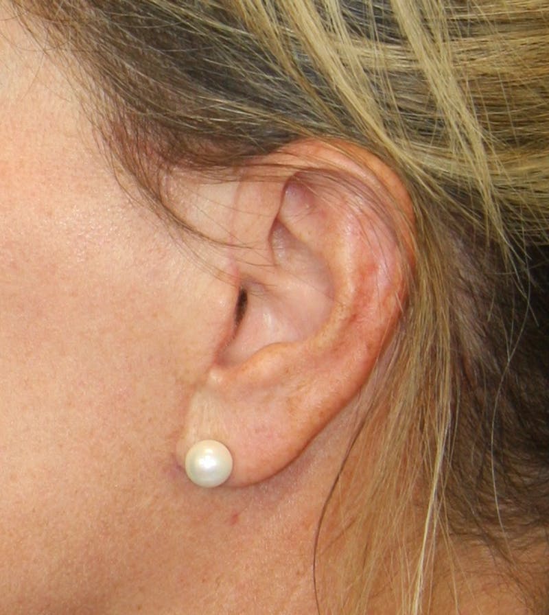 Incisions Before & After Gallery - Patient 181783109 - Image 1