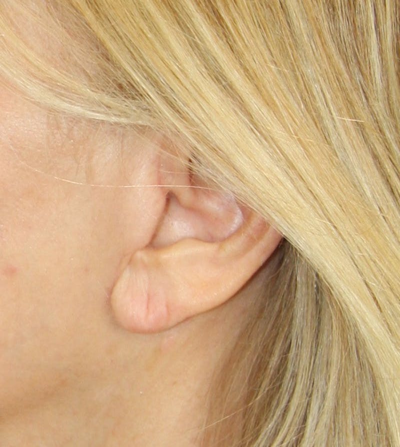 Incisions Before & After Gallery - Patient 181783139 - Image 1