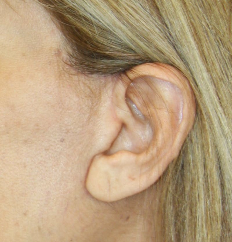 Incisions Before & After Gallery - Patient 181783141 - Image 1