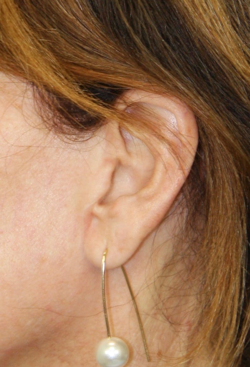 Incisions Before & After Gallery - Patient 181783142 - Image 1