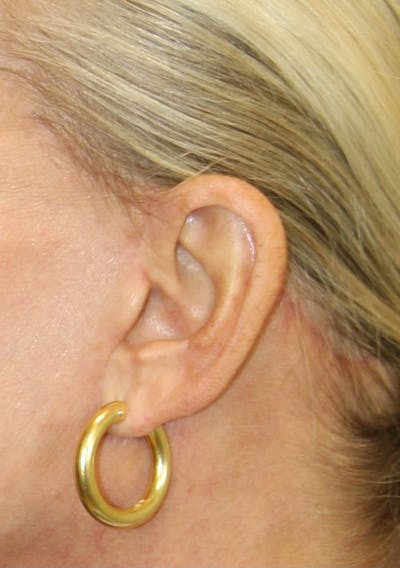 Incisions Before & After Gallery - Patient 181783168 - Image 1