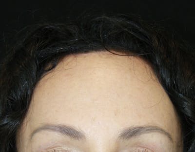 Incisions Before & After Gallery - Patient 181783208 - Image 1
