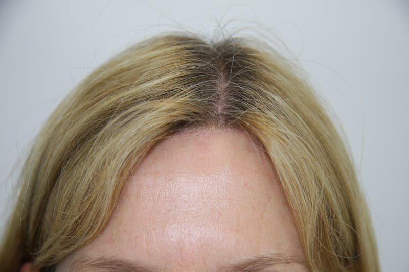 Incisions Before & After Gallery - Patient 181877050 - Image 1