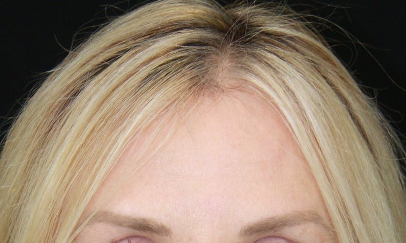 Incisions Before & After Gallery - Patient 181877051 - Image 1