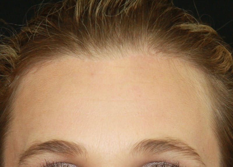 Incisions Before & After Gallery - Patient 181877454 - Image 1