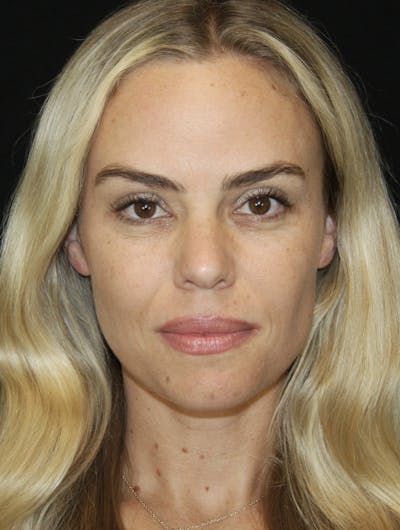 Liquid Facelift Before & After Gallery - Patient 181881521 - Image 1