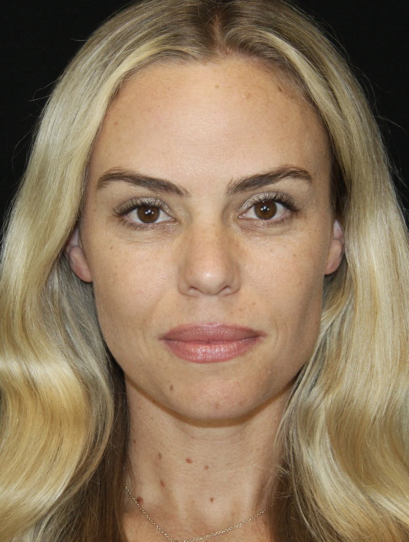 Liquid Facelift Before & After Gallery - Patient 181881521 - Image 1