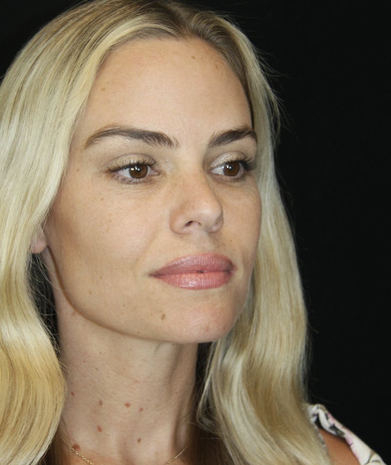 Liquid Facelift Before & After Gallery - Patient 181881521 - Image 5