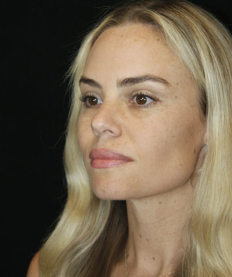 Liquid Facelift Before & After Gallery - Patient 181881521 - Image 3