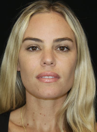 Liquid Facelift Before & After Gallery - Patient 181881521 - Image 2