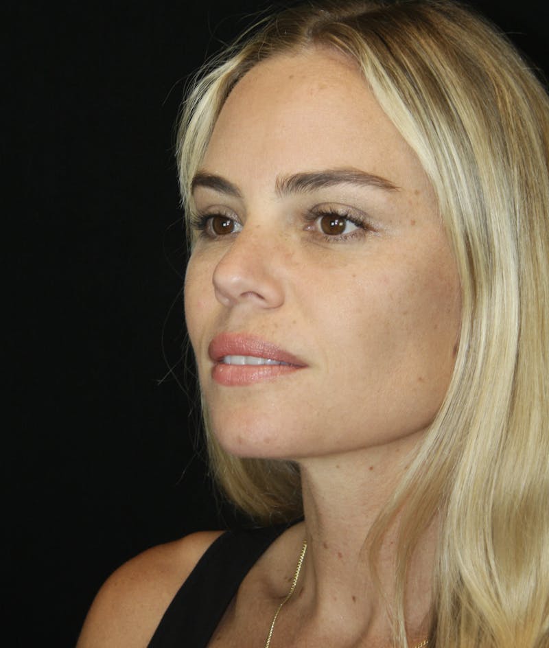 Liquid Facelift Before & After Gallery - Patient 181881521 - Image 4