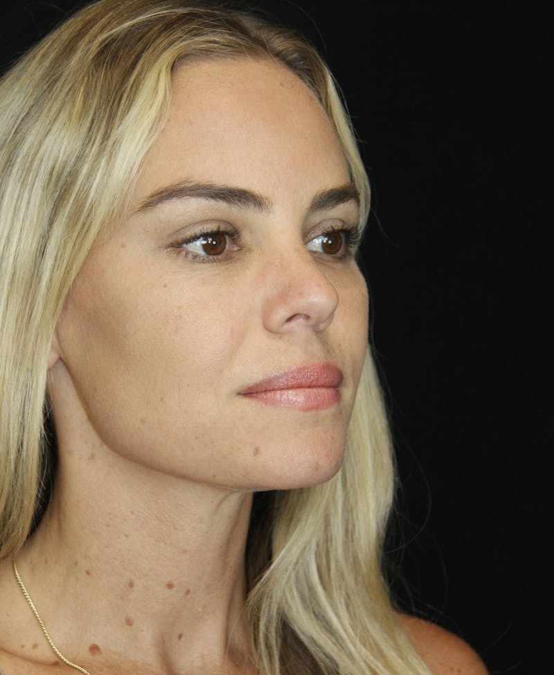 Liquid Facelift Before & After Gallery - Patient 181881521 - Image 6