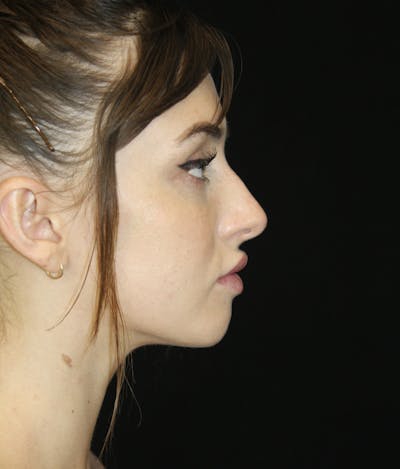 Non-Surgical Rhinoplasty Before & After Gallery - Patient 181881634 - Image 1