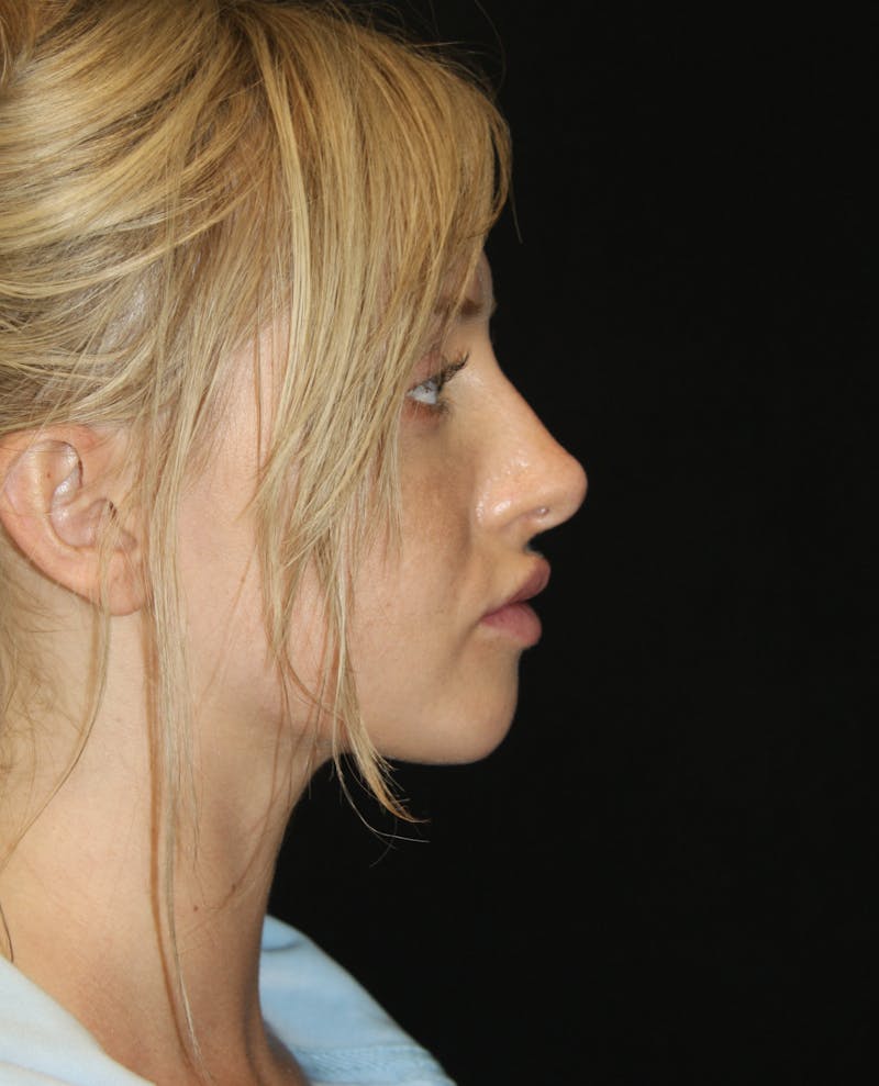 Non-Surgical Rhinoplasty Before & After Gallery - Patient 181881634 - Image 2