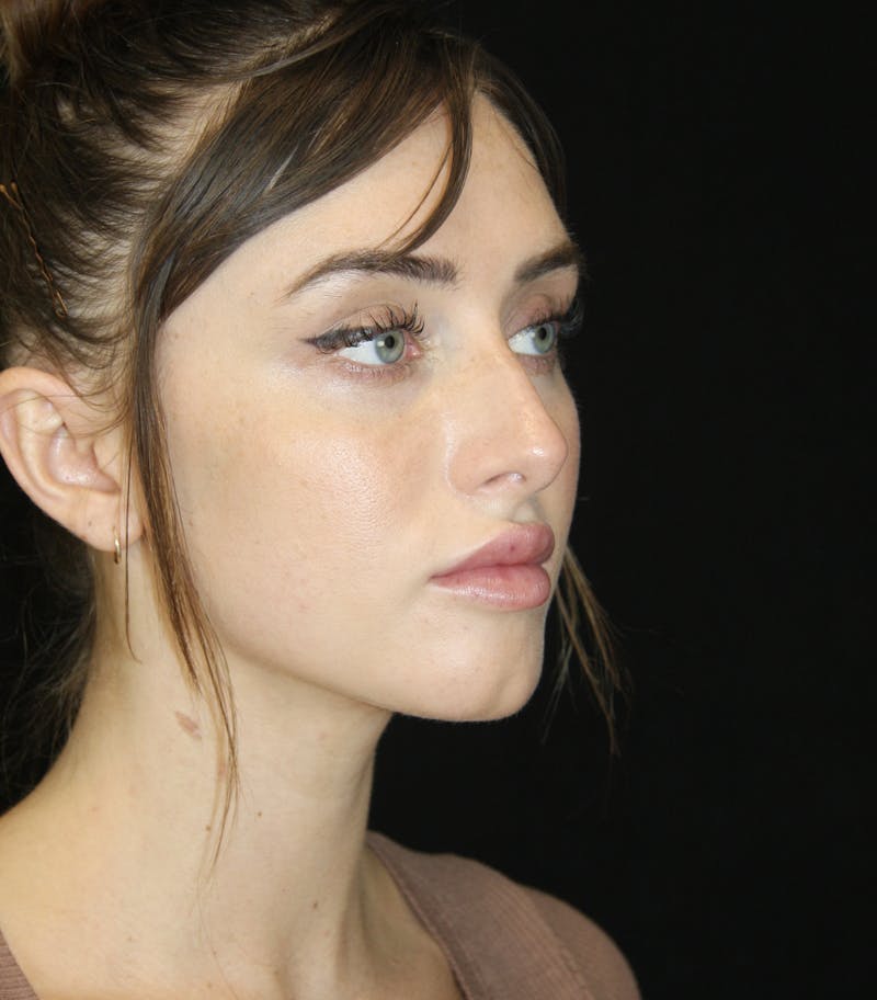 Non-Surgical Rhinoplasty Before & After Gallery - Patient 181881634 - Image 3